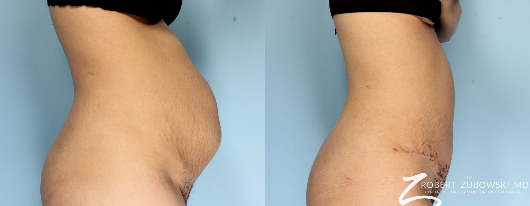 Liposuction - Thumbnail 2