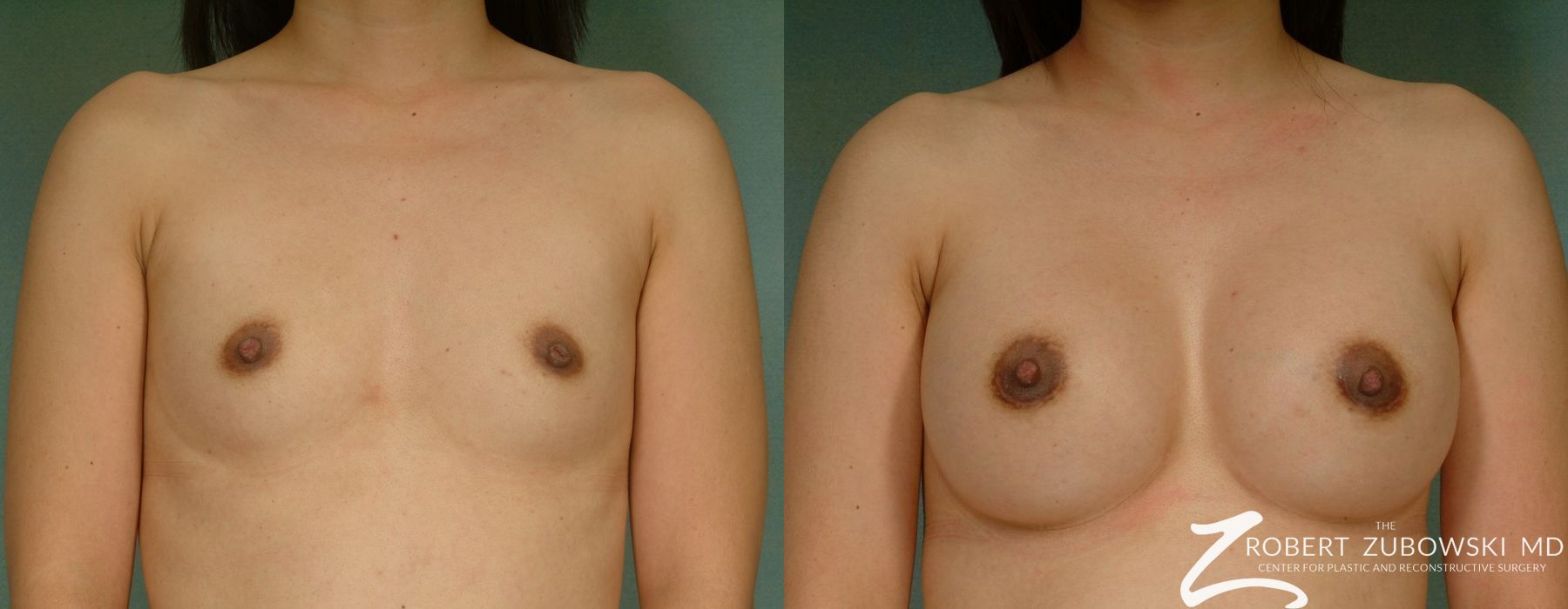Breast Augmentation - Case 3628