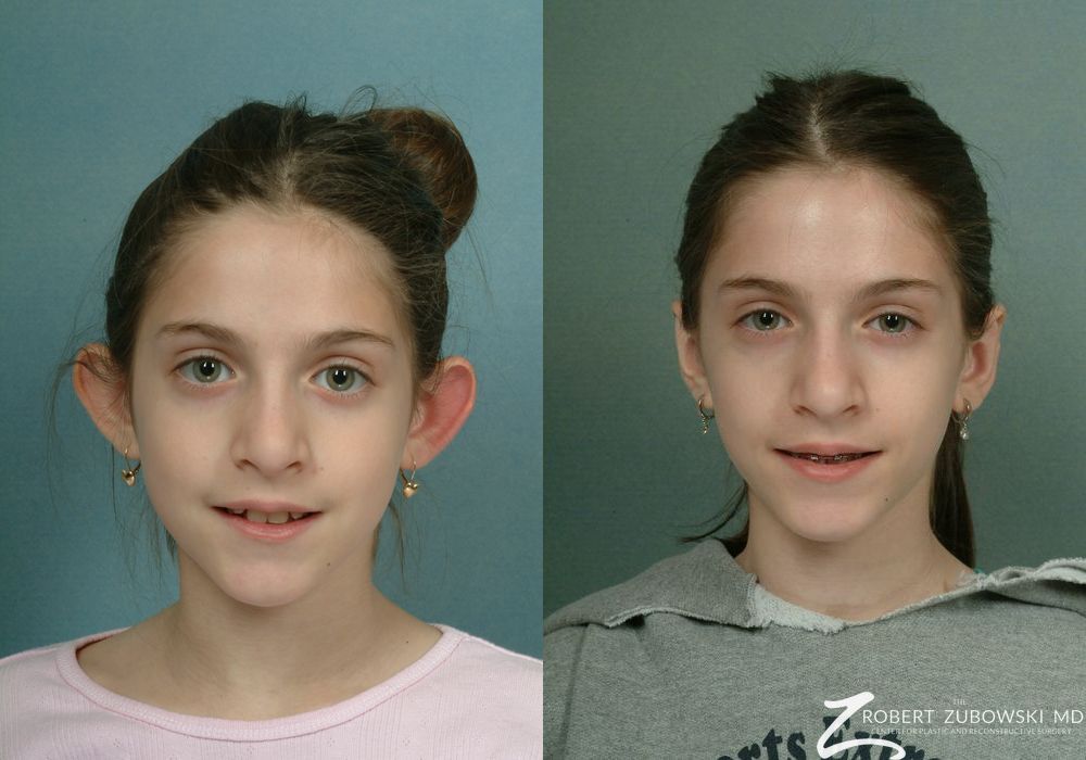 Otoplasty - Case 3859