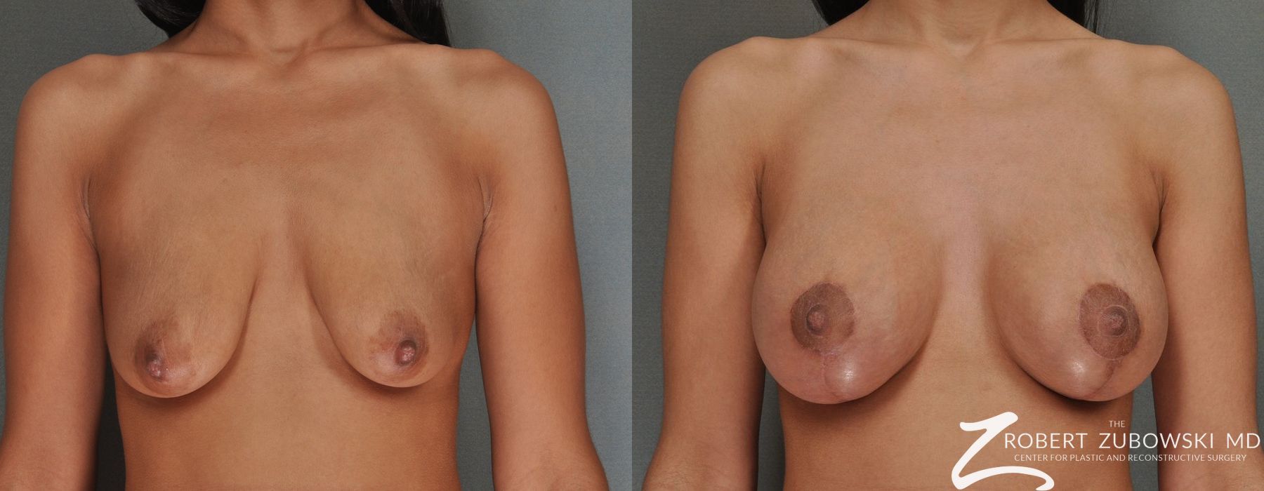Breast Lift and Augmentation - Case 3665