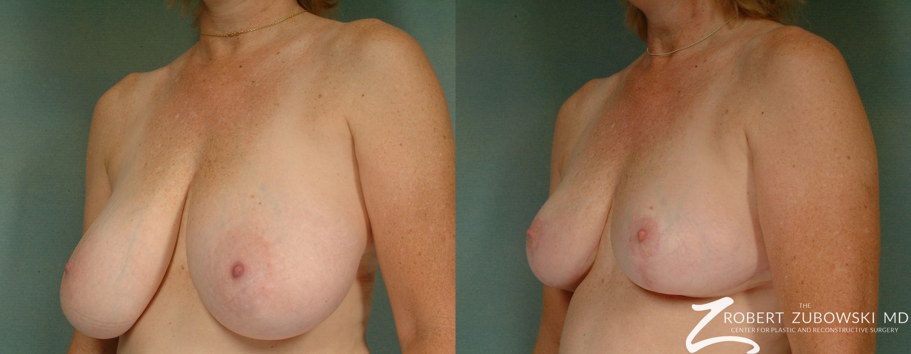 Breast Reduction - Thumbnail 2