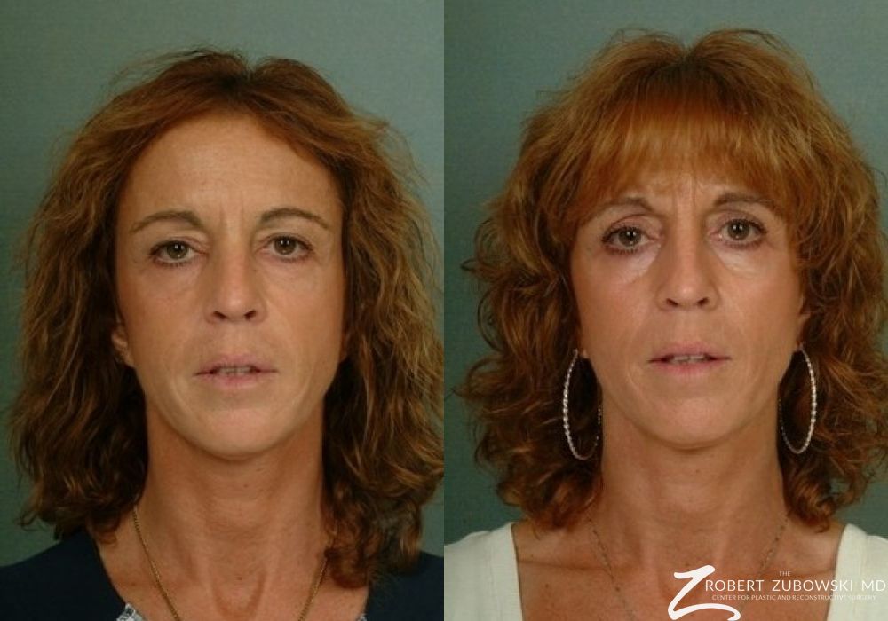 Blepharoplasty - Case 3746
