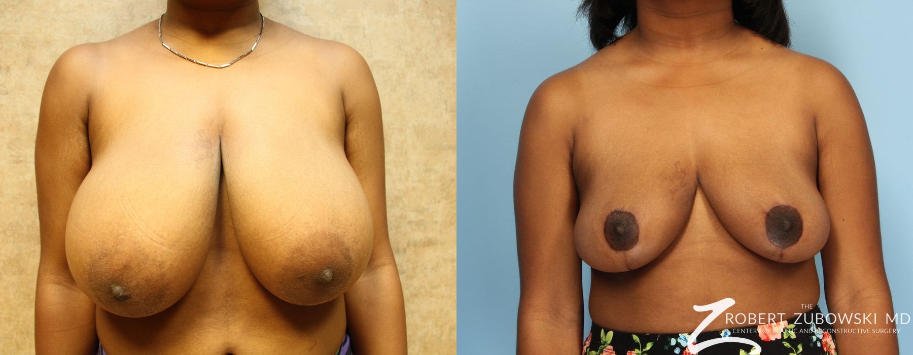 Breast Reduction - Case 3686