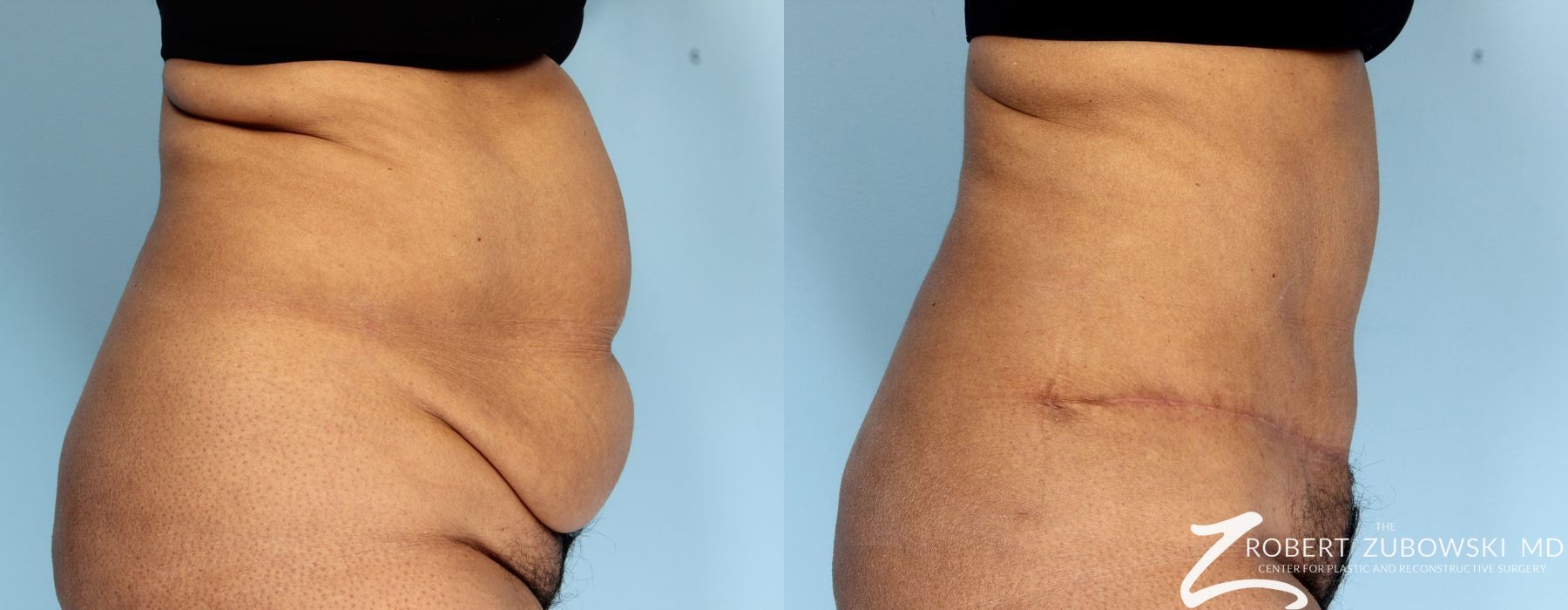 Tummy Tuck - Thumbnail 2