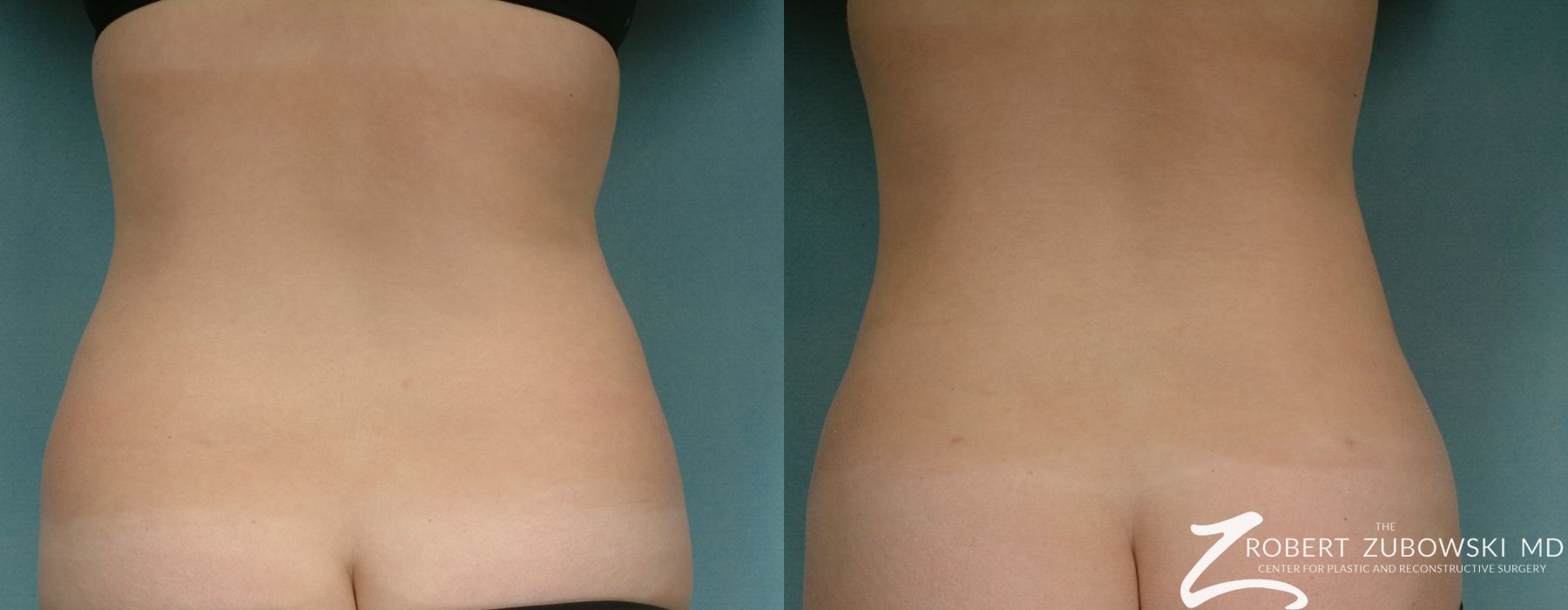 Liposuction - Thumbnail 2