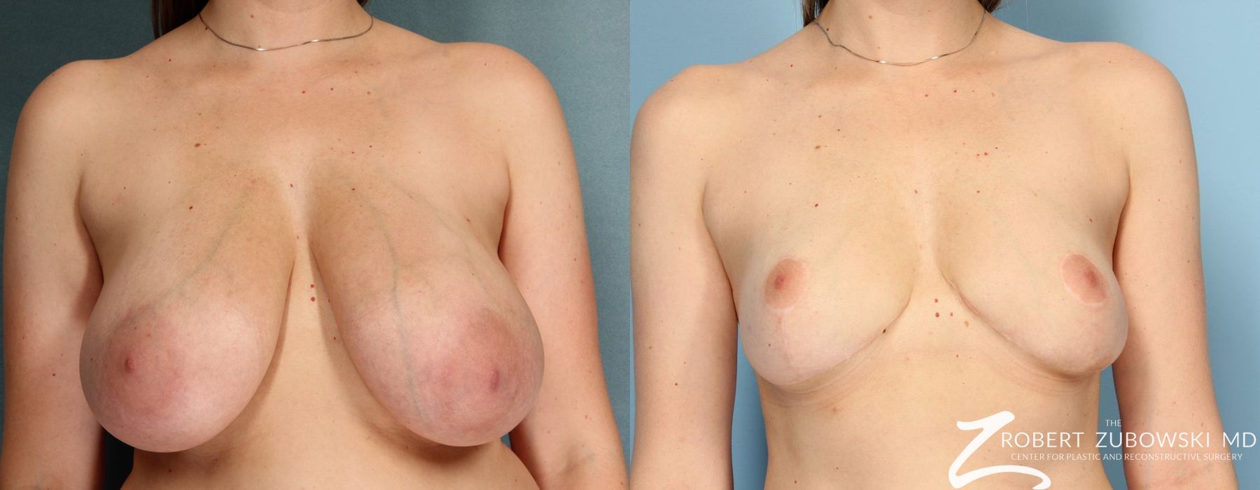 Breast Reduction - Case 3688