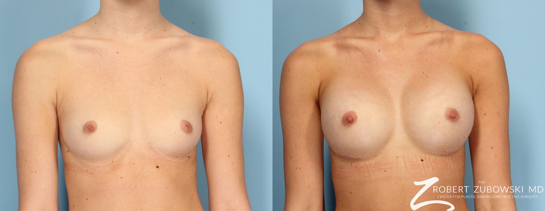 Before and after procedure result