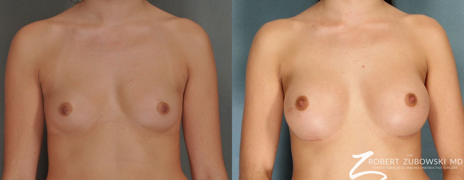 Breast Augmentation - Case 3616
