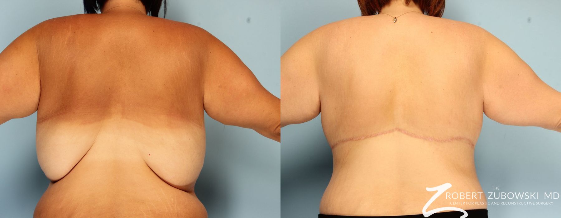 Body Lift - Thumbnail 2