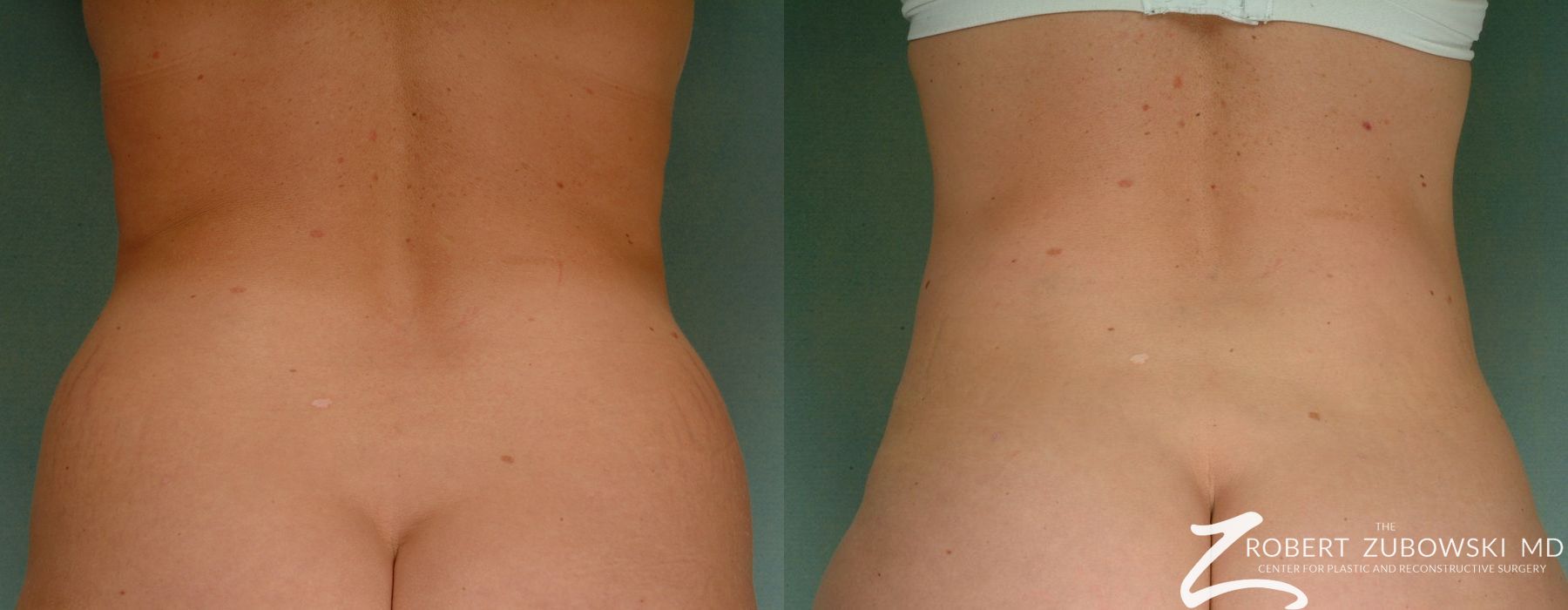 Liposuction - Case 3555