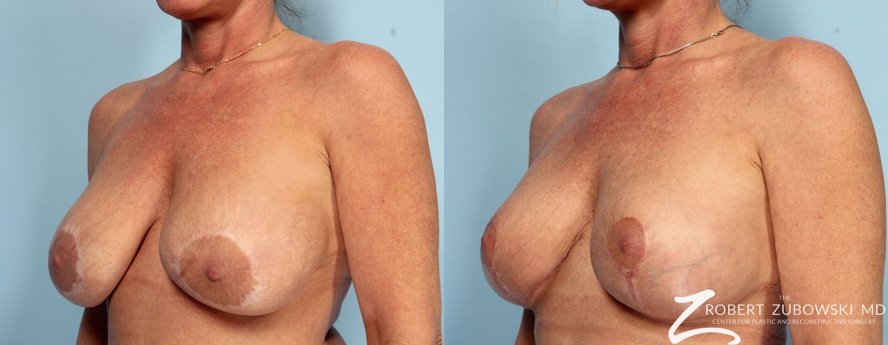 Breast Lift and Augmentation - Thumbnail 2