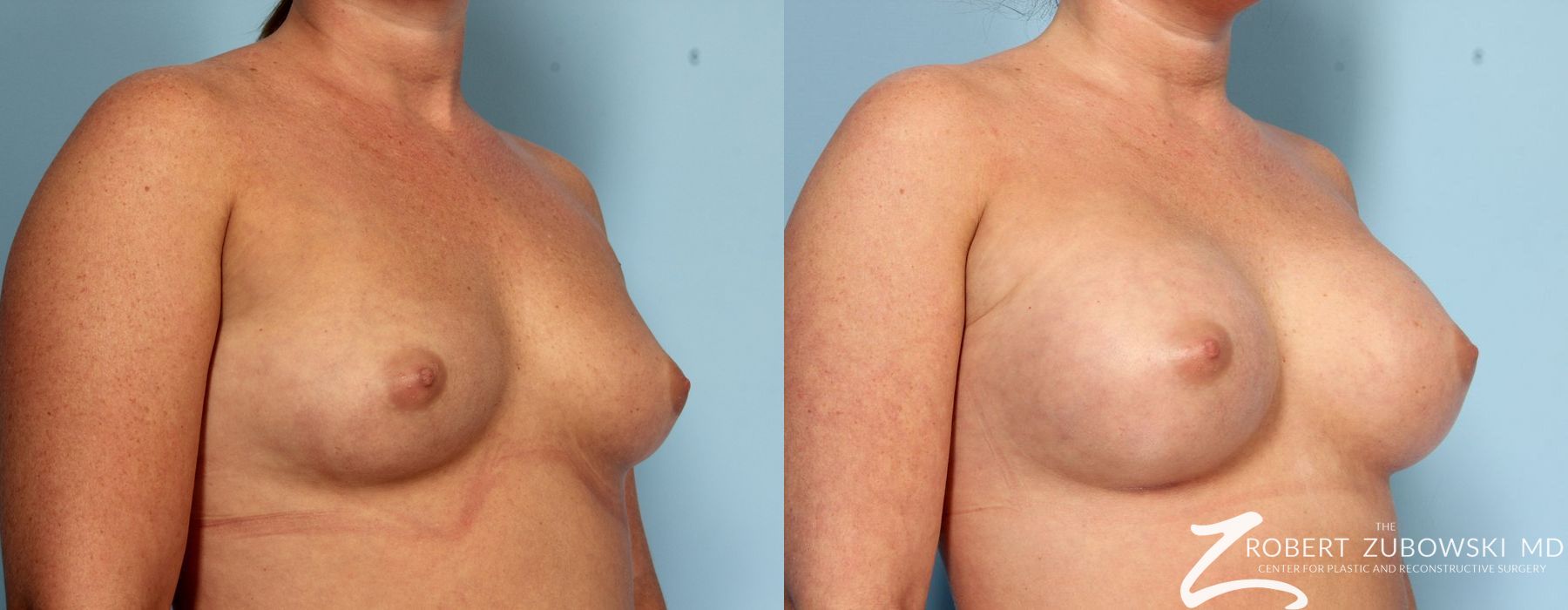 Breast Augmentation - Thumbnail 2