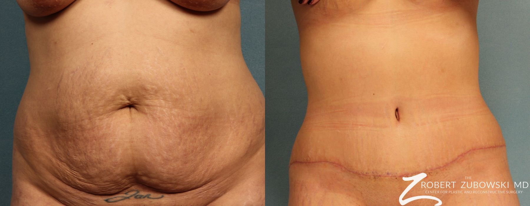 Tummy Tuck - Case 3582