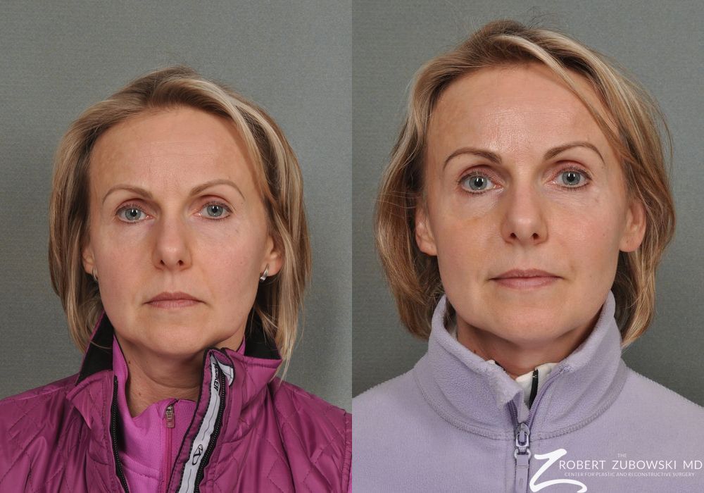 BOTOX® Cosmetic - Case 3900