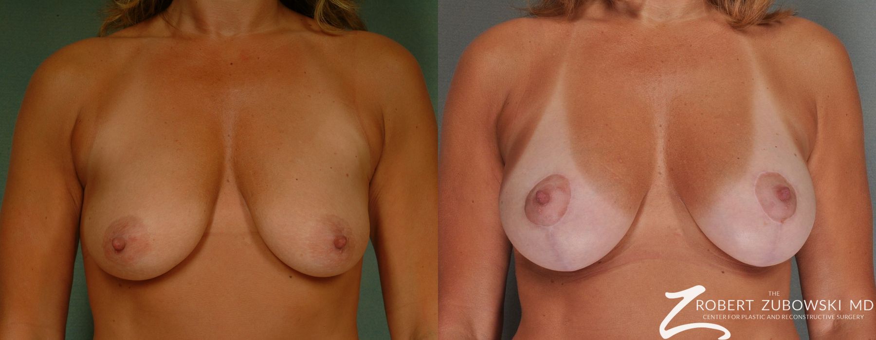 Breast Lift and Augmentation - Case 3676
