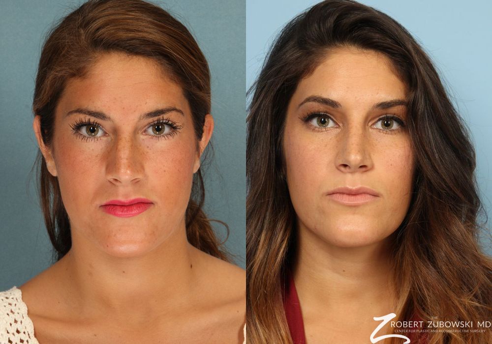 Rhinoplasty - Case 3878