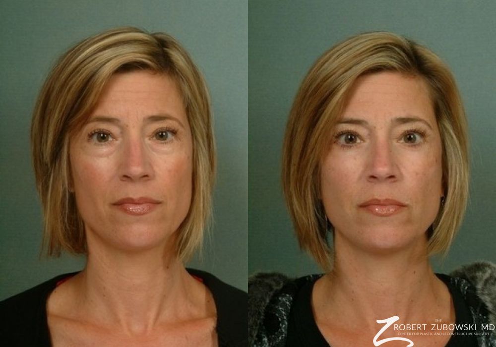 Blepharoplasty - Case 3745