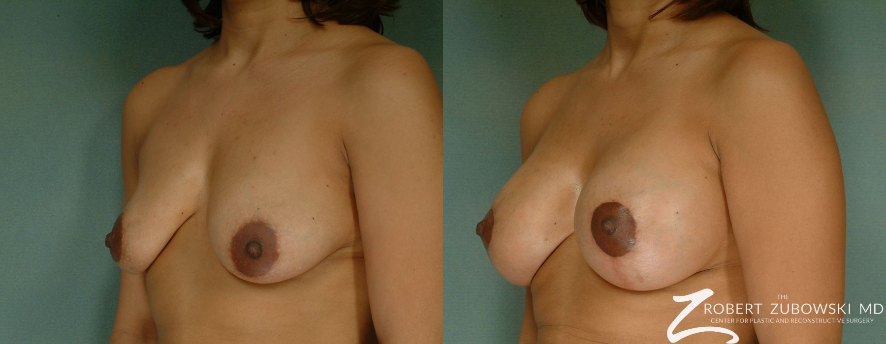 Breast Lift and Augmentation - Thumbnail 2