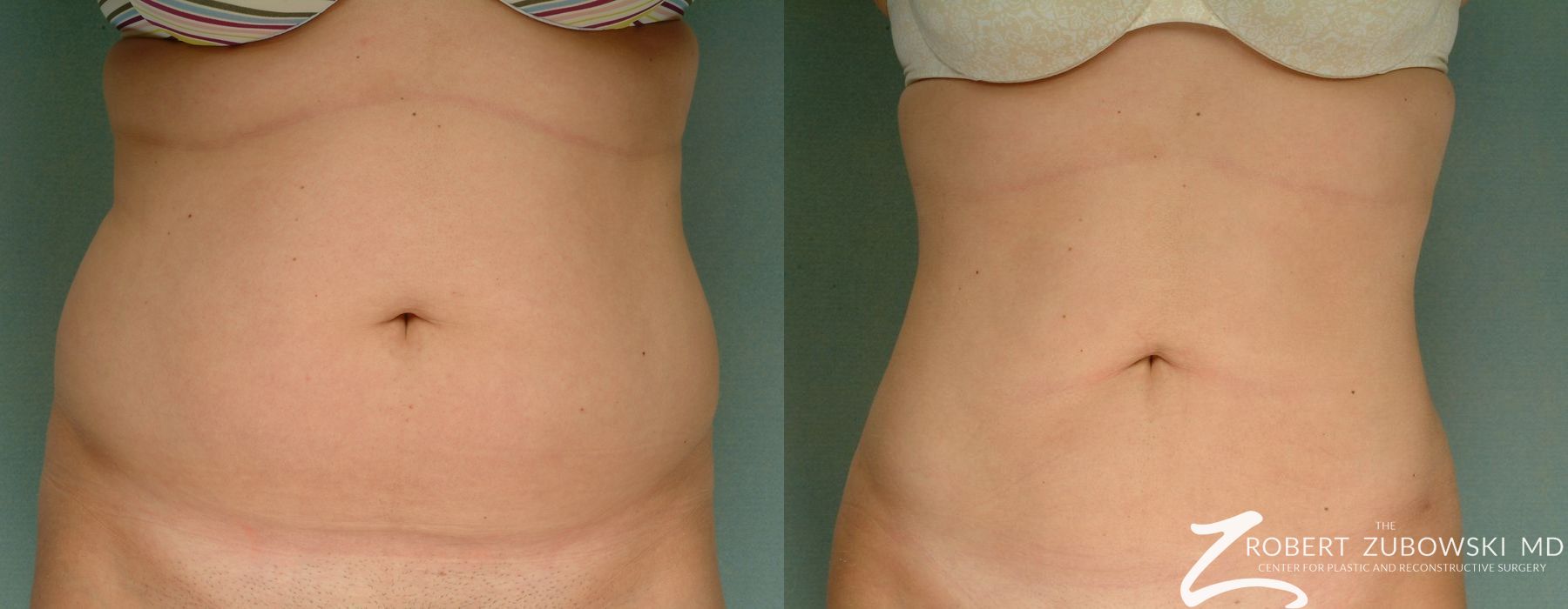 Liposuction - Case 3545