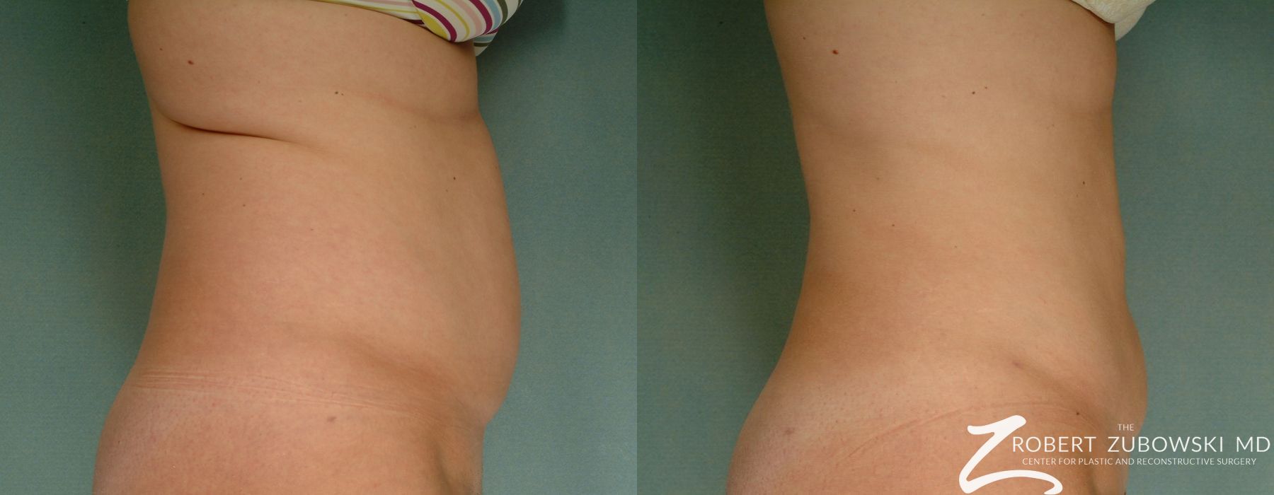 Liposuction - Thumbnail 2