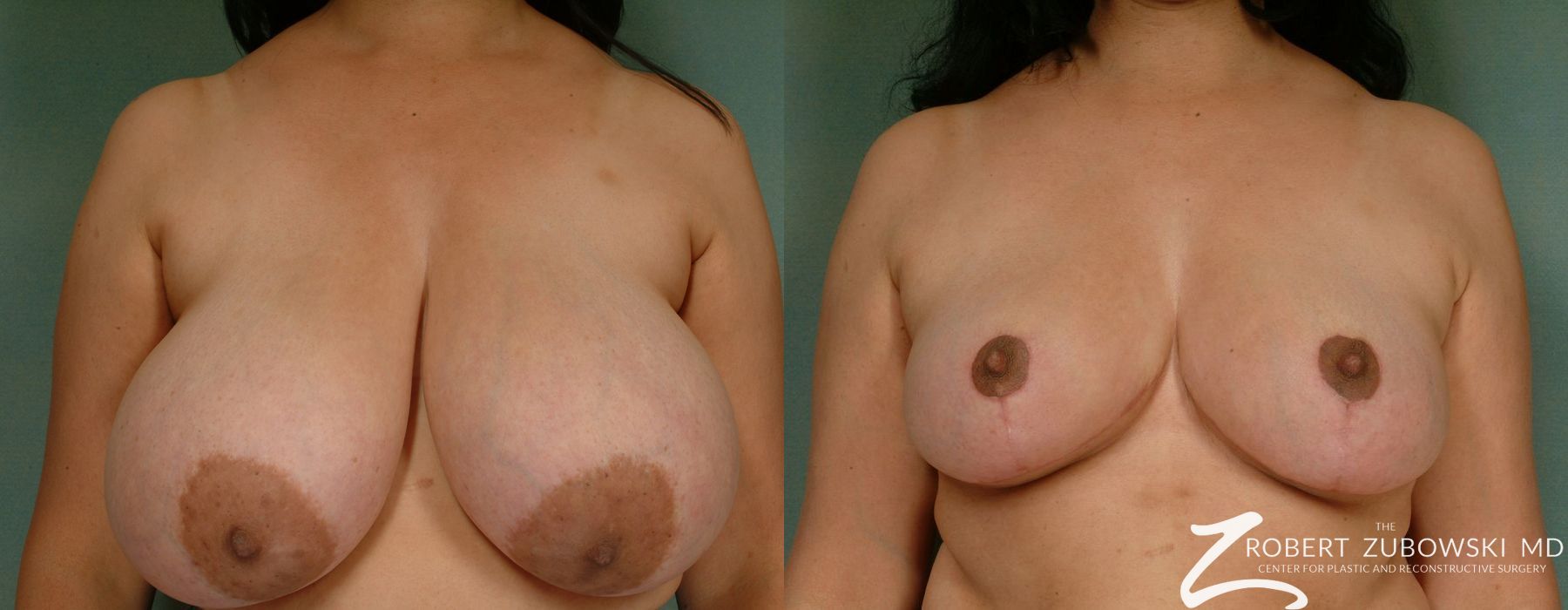Breast Reduction - Case 3692