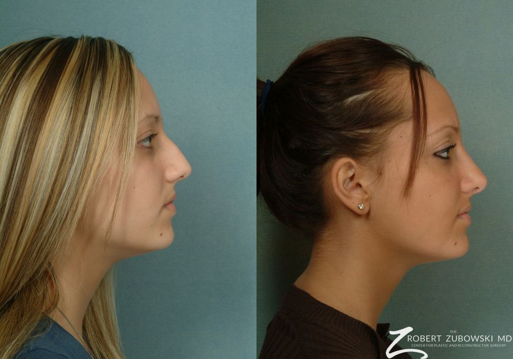 Rhinoplasty - Thumbnail 2