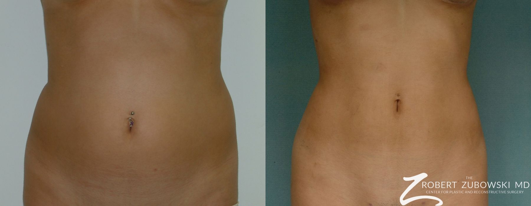 Liposuction - Case 3553