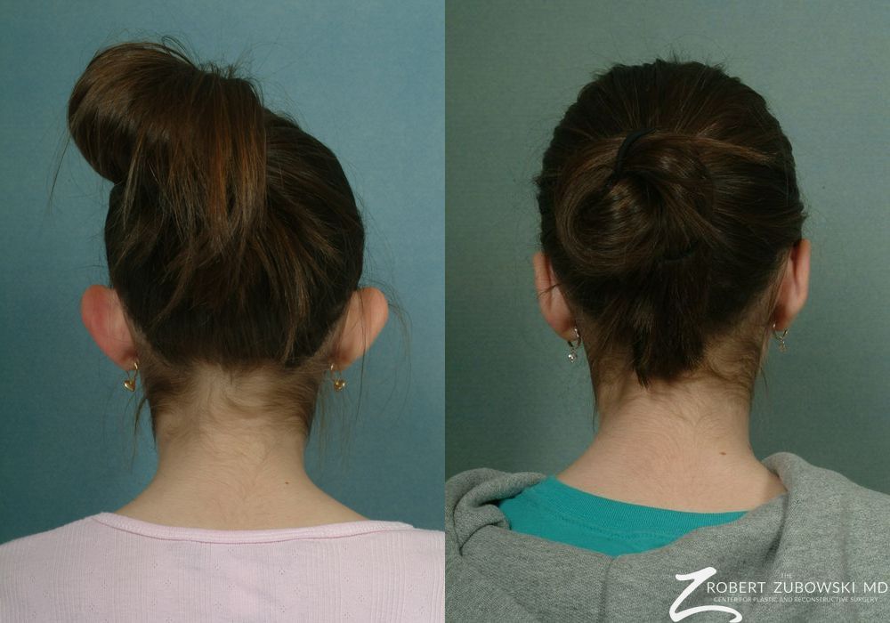 Otoplasty - Thumbnail 2