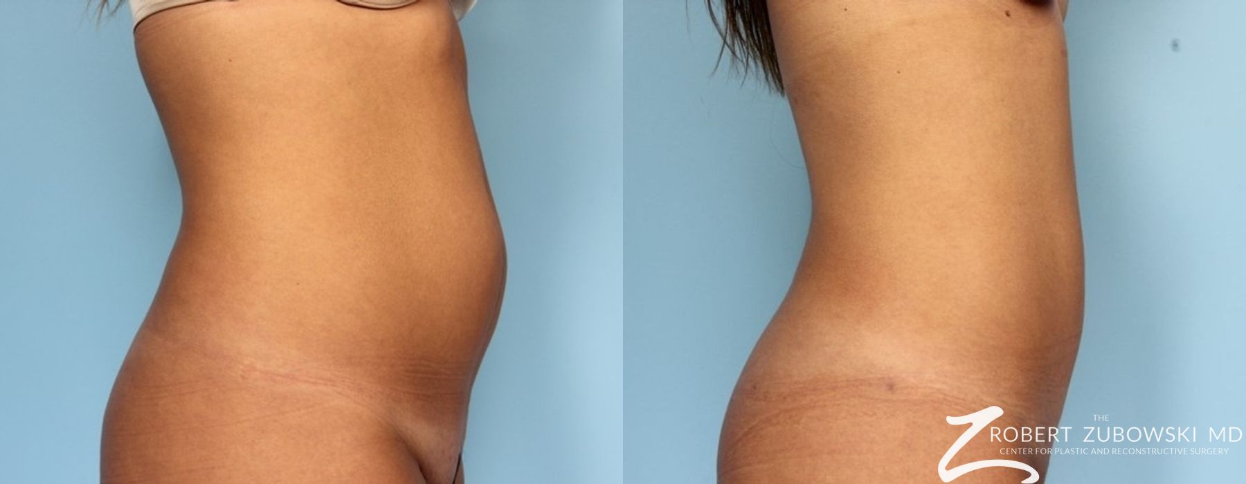 Liposuction - Thumbnail 2