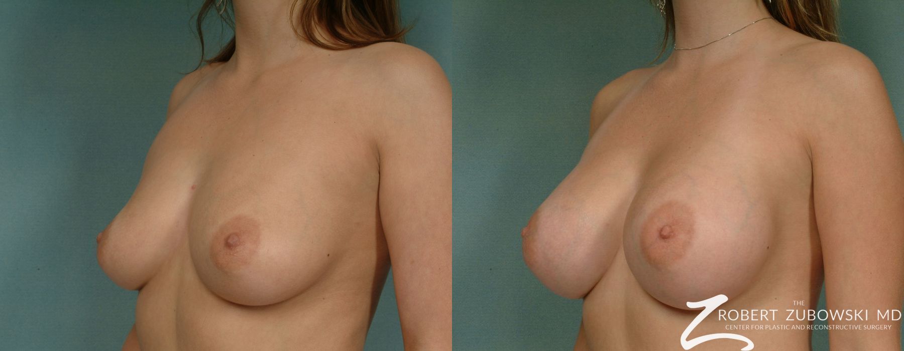 Breast Augmentation - Thumbnail 2