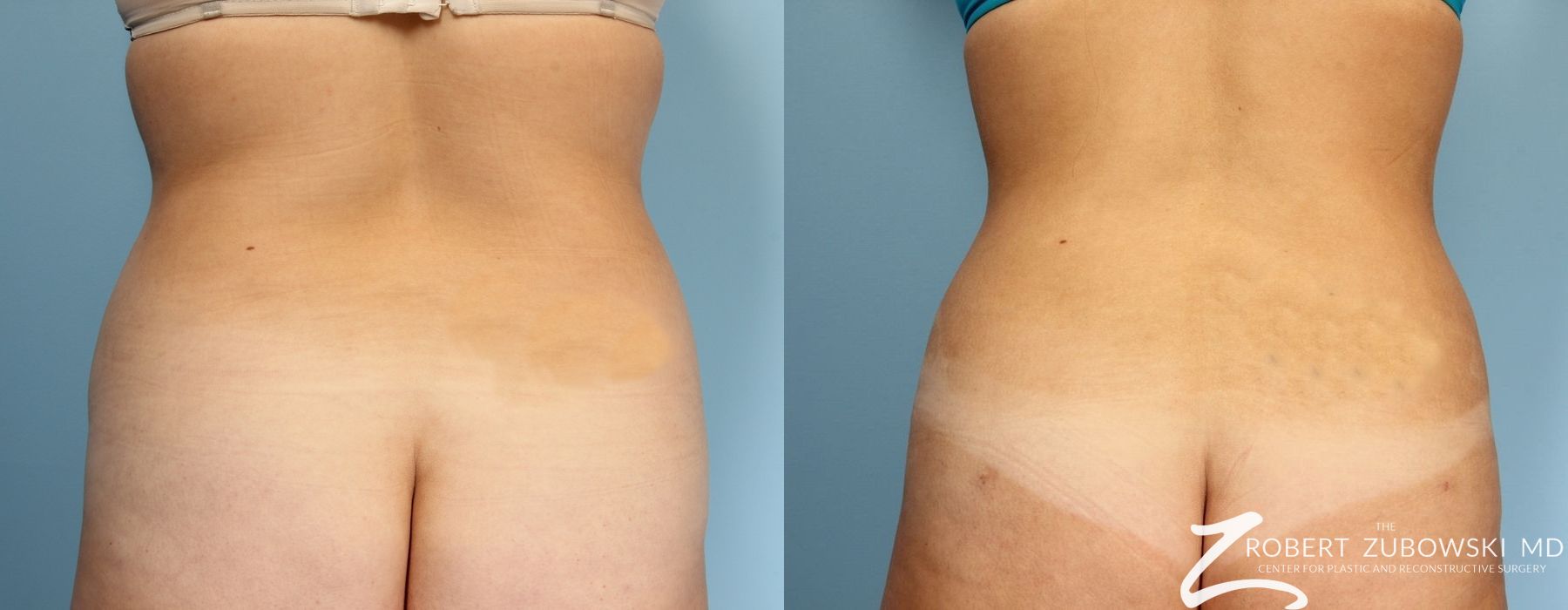 Liposuction - Case 3534
