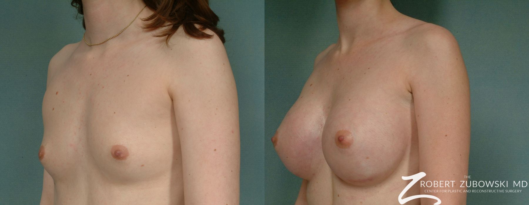 Breast Augmentation - Thumbnail 2