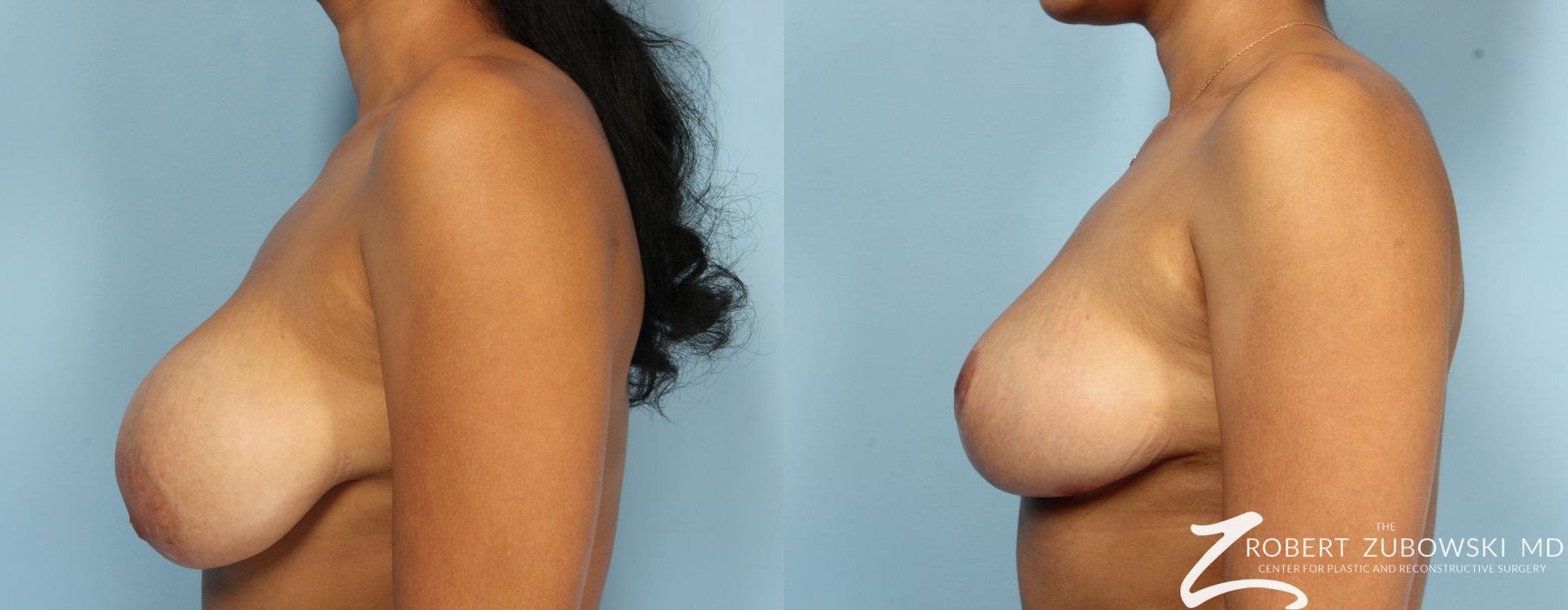 Breast Revision - Thumbnail 3