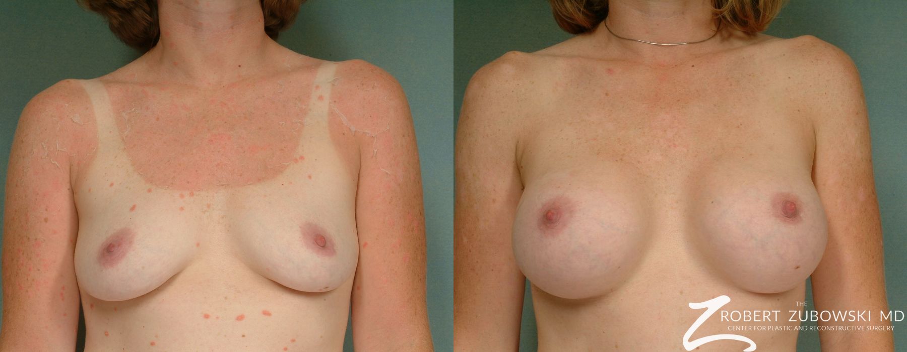 Breast Augmentation - Case 3631