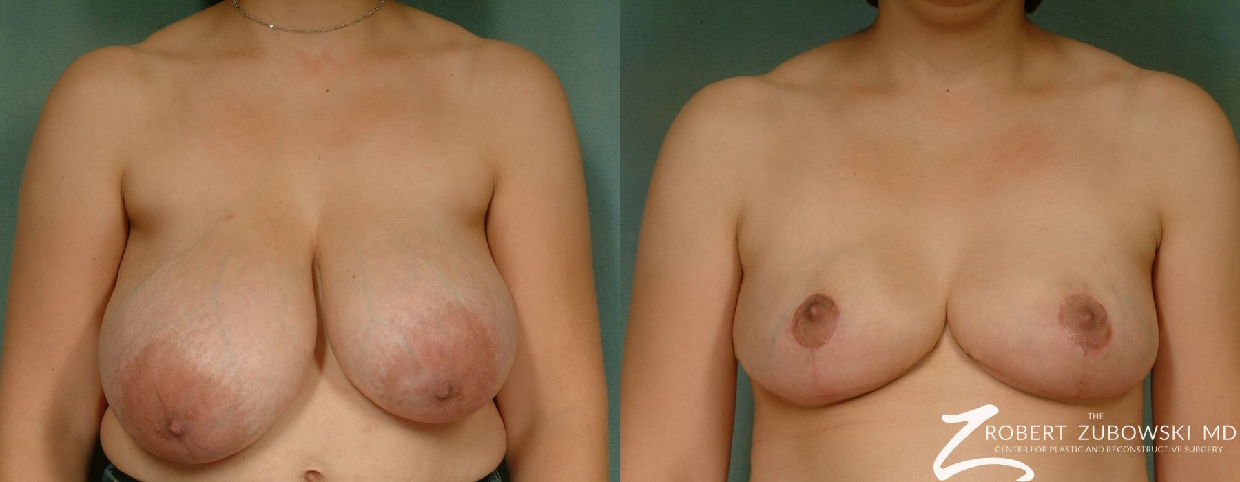 Breast Reduction - Case 3704