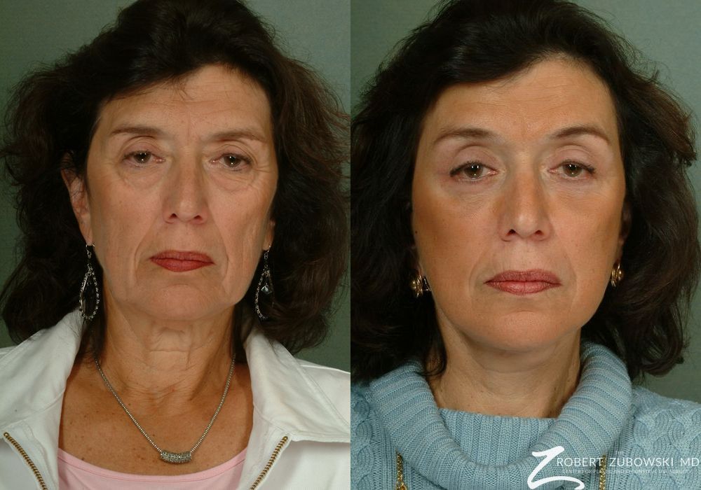 Brow Lift - Case 3785