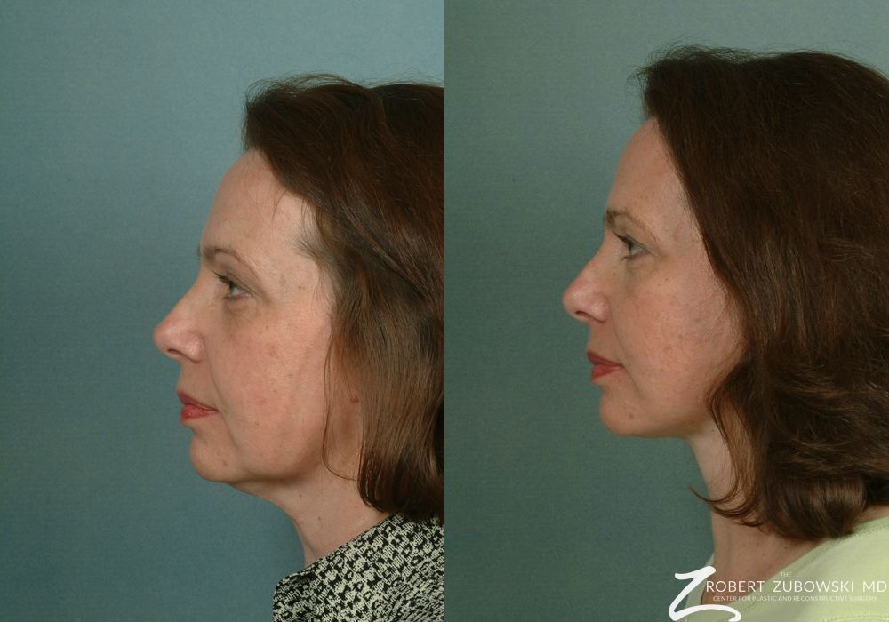 Facelift - Thumbnail 2