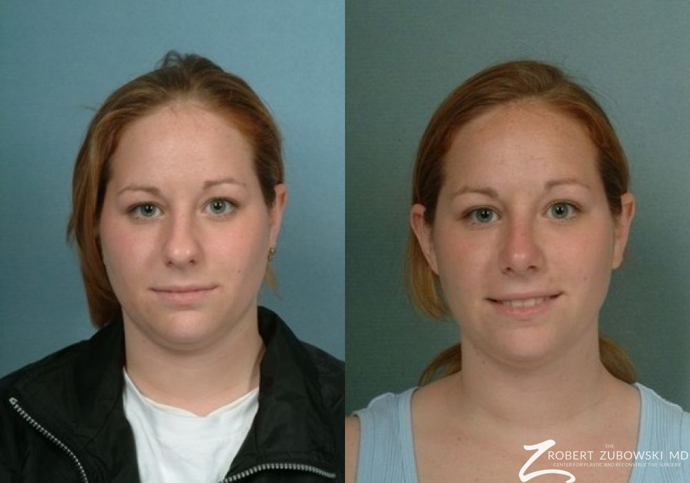 Rhinoplasty - Case 3884