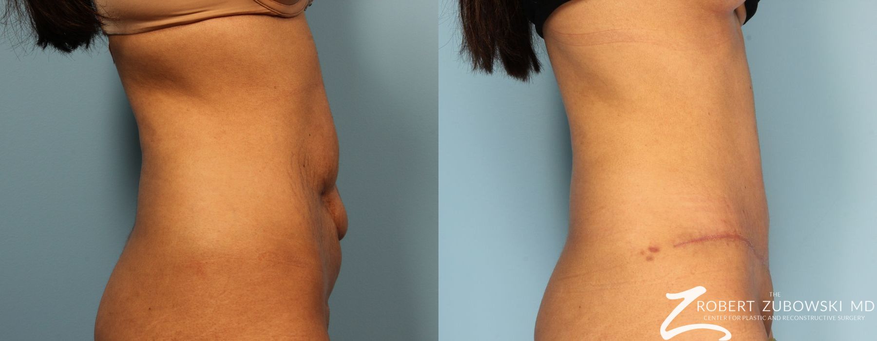 Tummy Tuck - Thumbnail 2