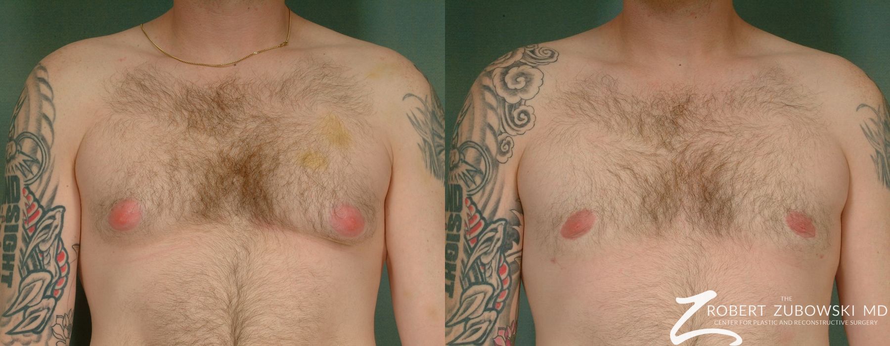 Gynecomastia - Case 3723