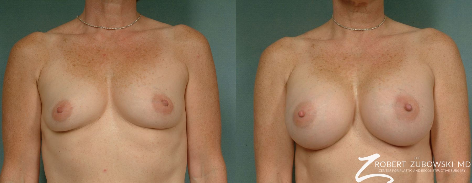 Breast Augmentation - Case 3624
