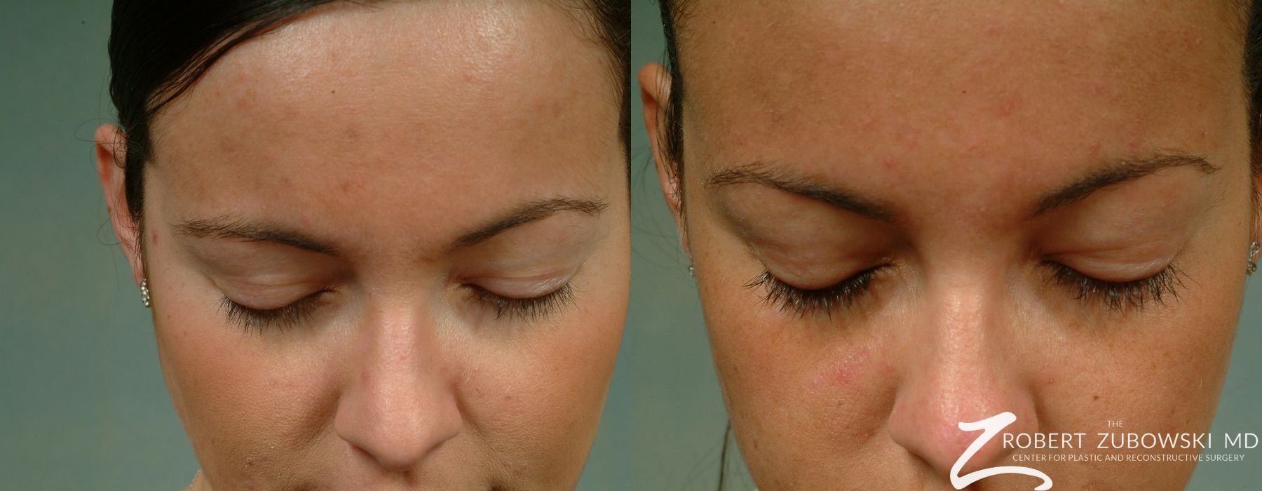 Latisse - Thumbnail 2