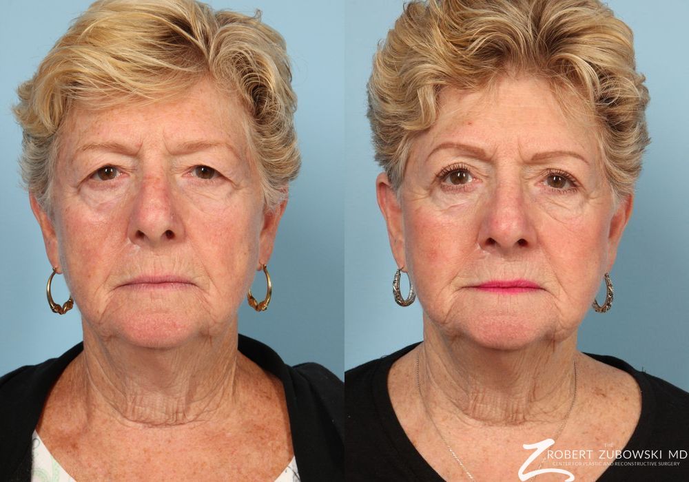 Blepharoplasty - Case 3757