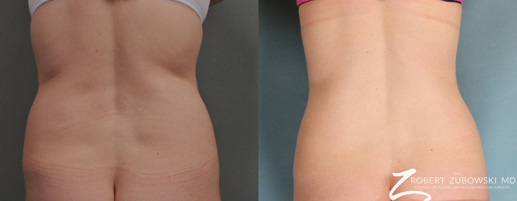 Liposuction - Case 3540