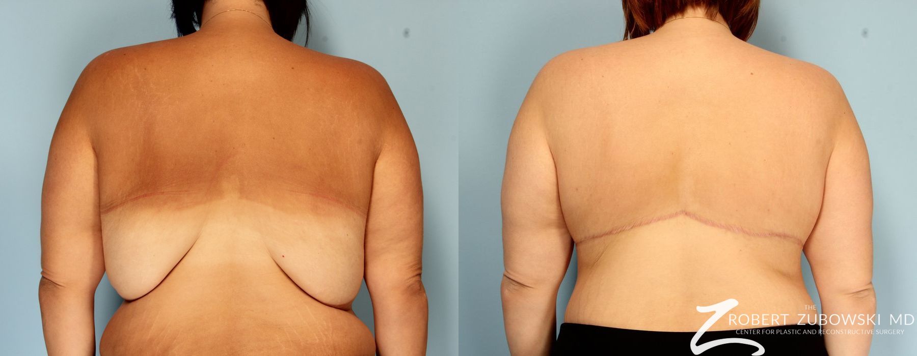 Before and after procedure result