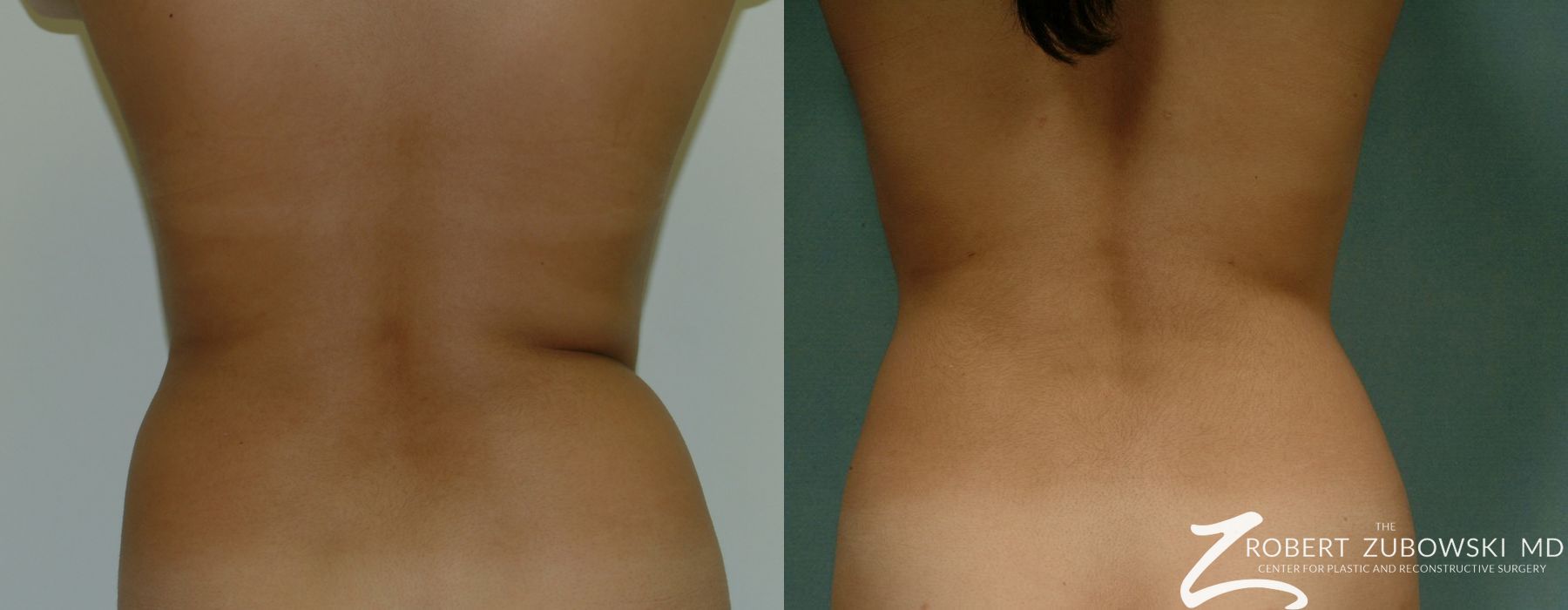 Liposuction - Thumbnail 2