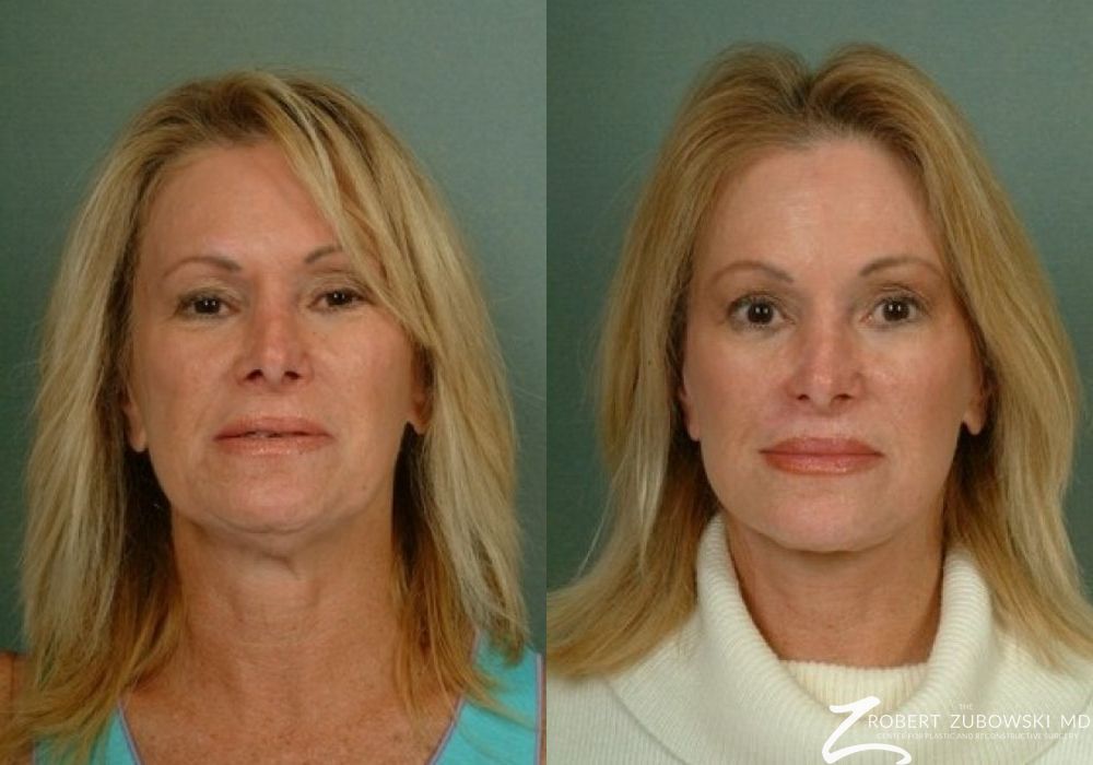 Before and after procedure result