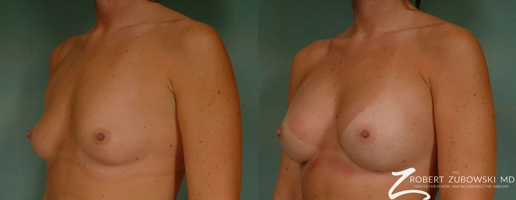 Breast Augmentation - Thumbnail 2