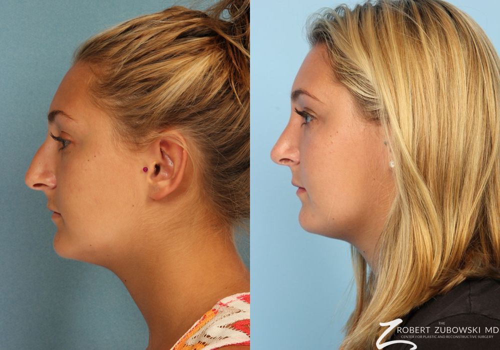 Rhinoplasty - Thumbnail 2