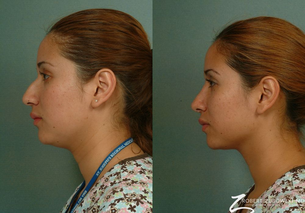 Rhinoplasty - Thumbnail 2